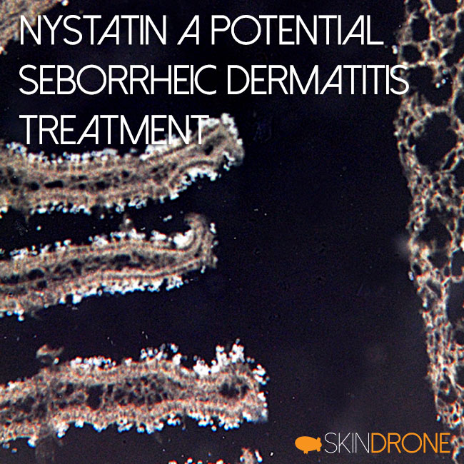 Nystatin A Potential Seborrheic Dermatitis Treatment Cover Photo
